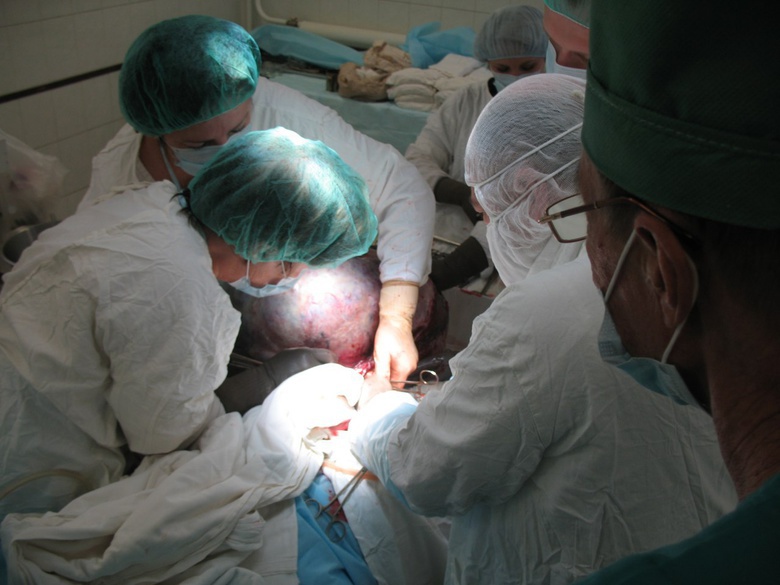 Хирурги ОКБ удалили томичке гигантскую опухоль матки весом в 22 кг