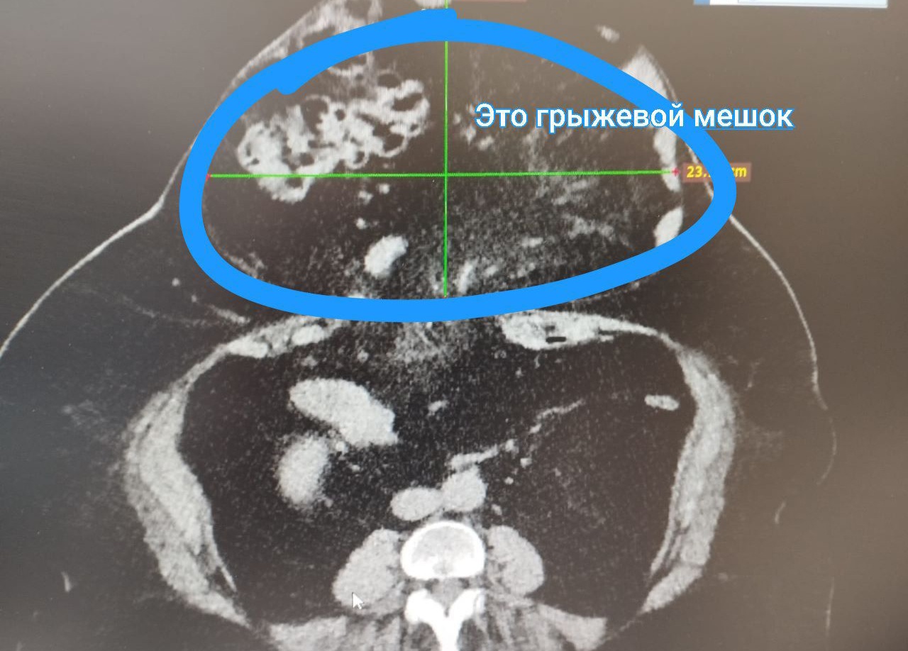 Томские хирурги избавили пенсионерку от огромной грыжи, с которой она жила  10 лет | 23.06.2023 | Томск - БезФормата