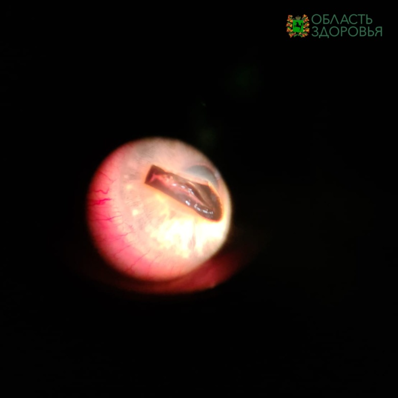 Томские офтальмологи извлекли из глаза пациента осколок металла длиной в 6 мм